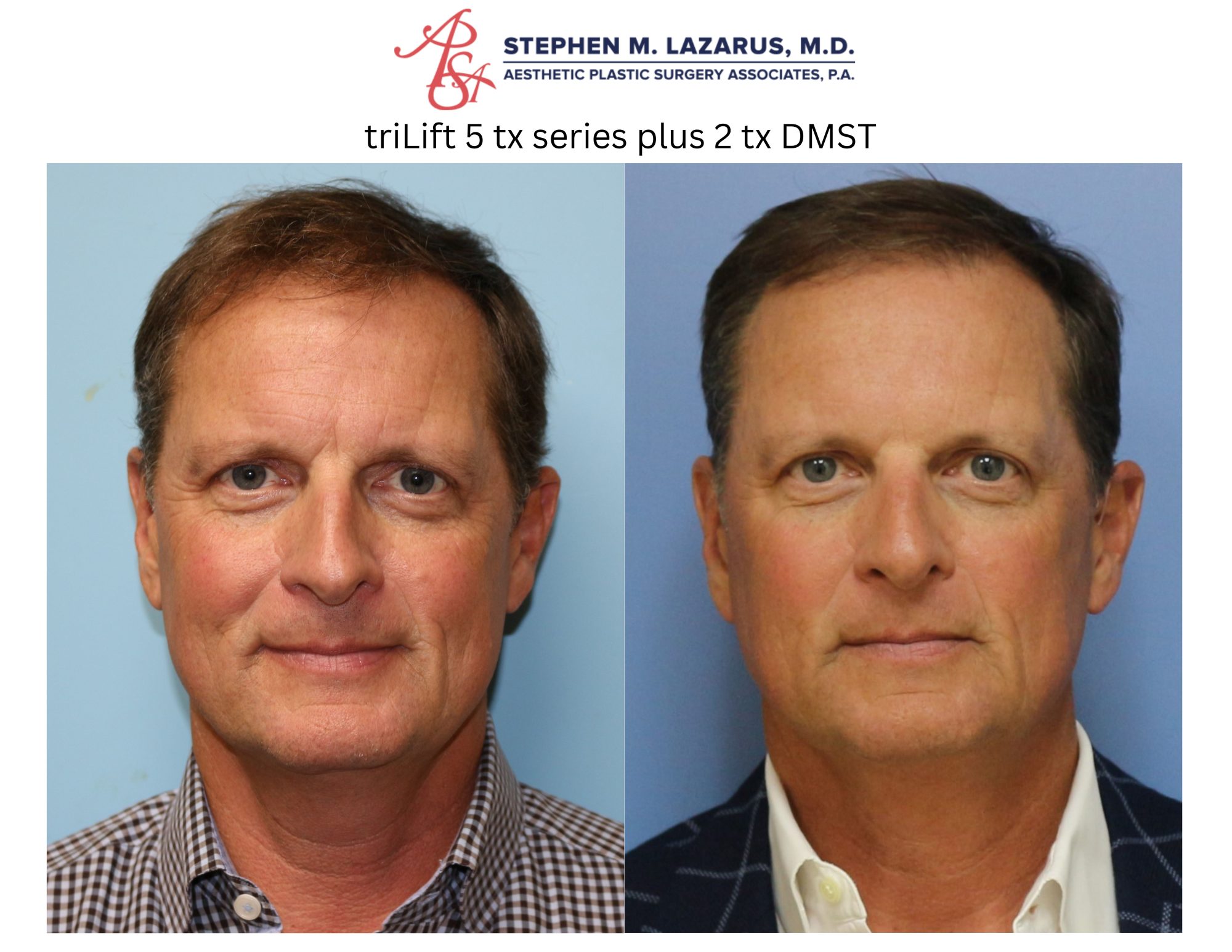 trilift facelift before and after